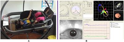 Clinical Findings in Patients With Persistent Positional Nystagmus: The Designation of “Heavy and Light Cupula”